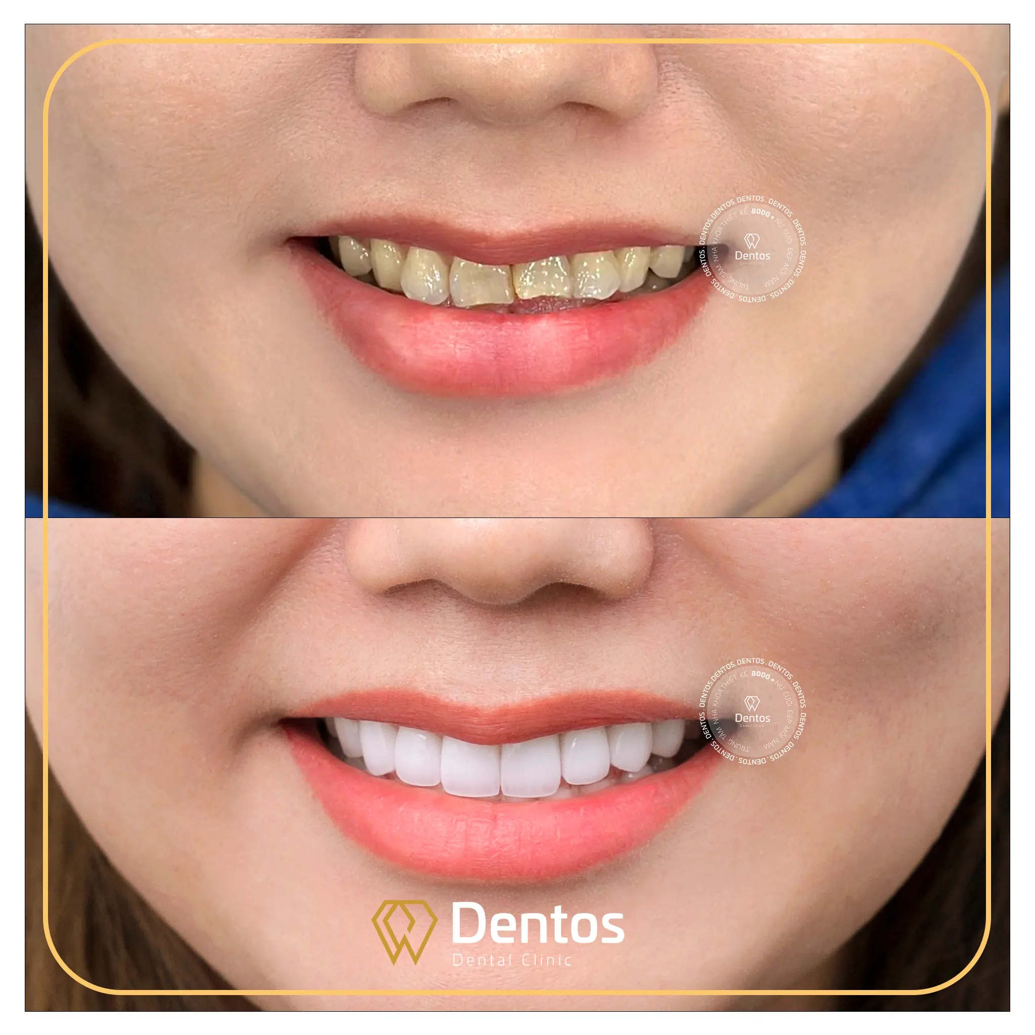 Bọc răng sứ giúp khôi phục thẩm mỹ và bảo vệ chân răng bị vỡ, mẻ